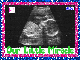 Sonogram (with boarder)- Our Little Miracle